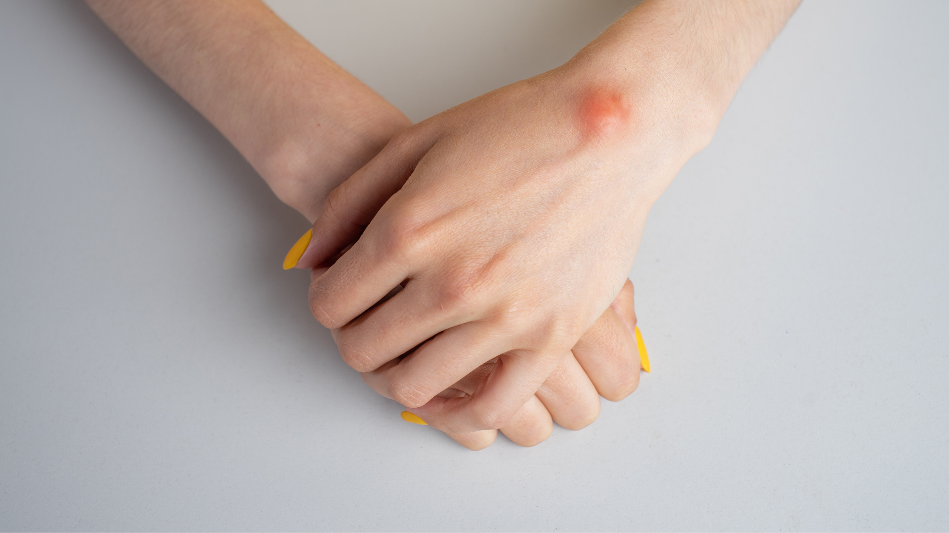 ganglion cyst treatment boise